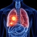 The Hidden Dangers of Radon Exposure: Beyond Lung Cancer
